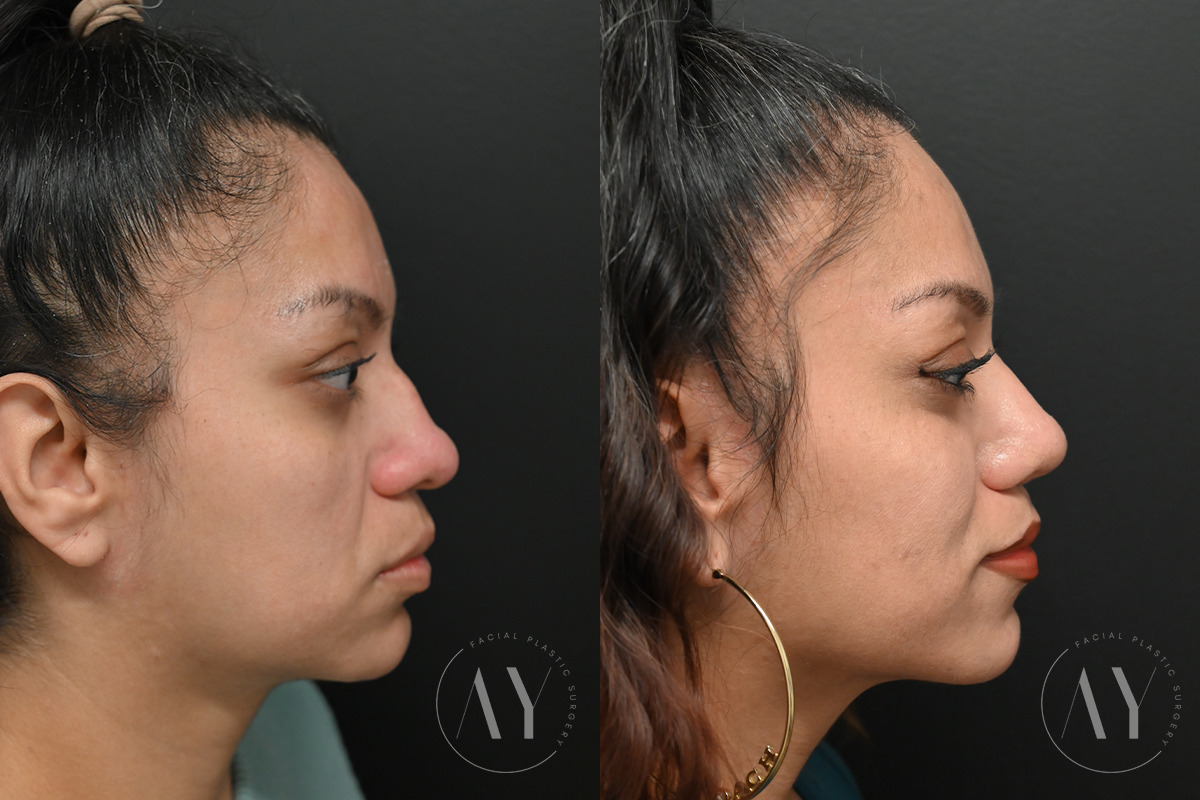 Patient 6096, Revision Rhinoplasy before and after photos Revision Rhinoplasy before and after photos in Princeton, NJ, Patient 6096