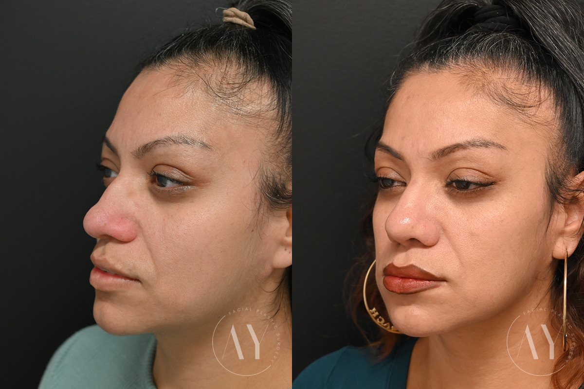 Patient 6096, Revision Rhinoplasy before and after photos Revision Rhinoplasy before and after photos in Princeton, NJ, Patient 6096