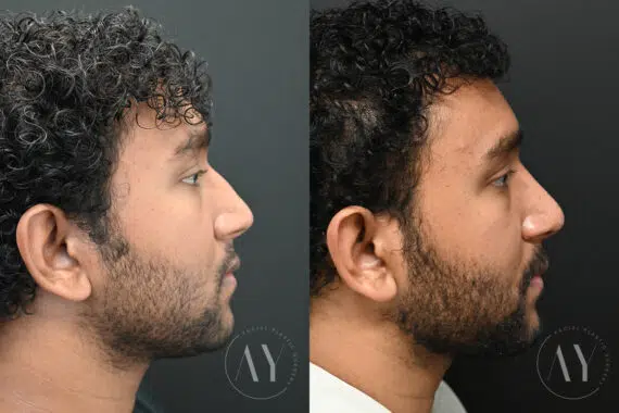 Rhinoplasty before and after photos in Princeton, NJ, Patient 6122