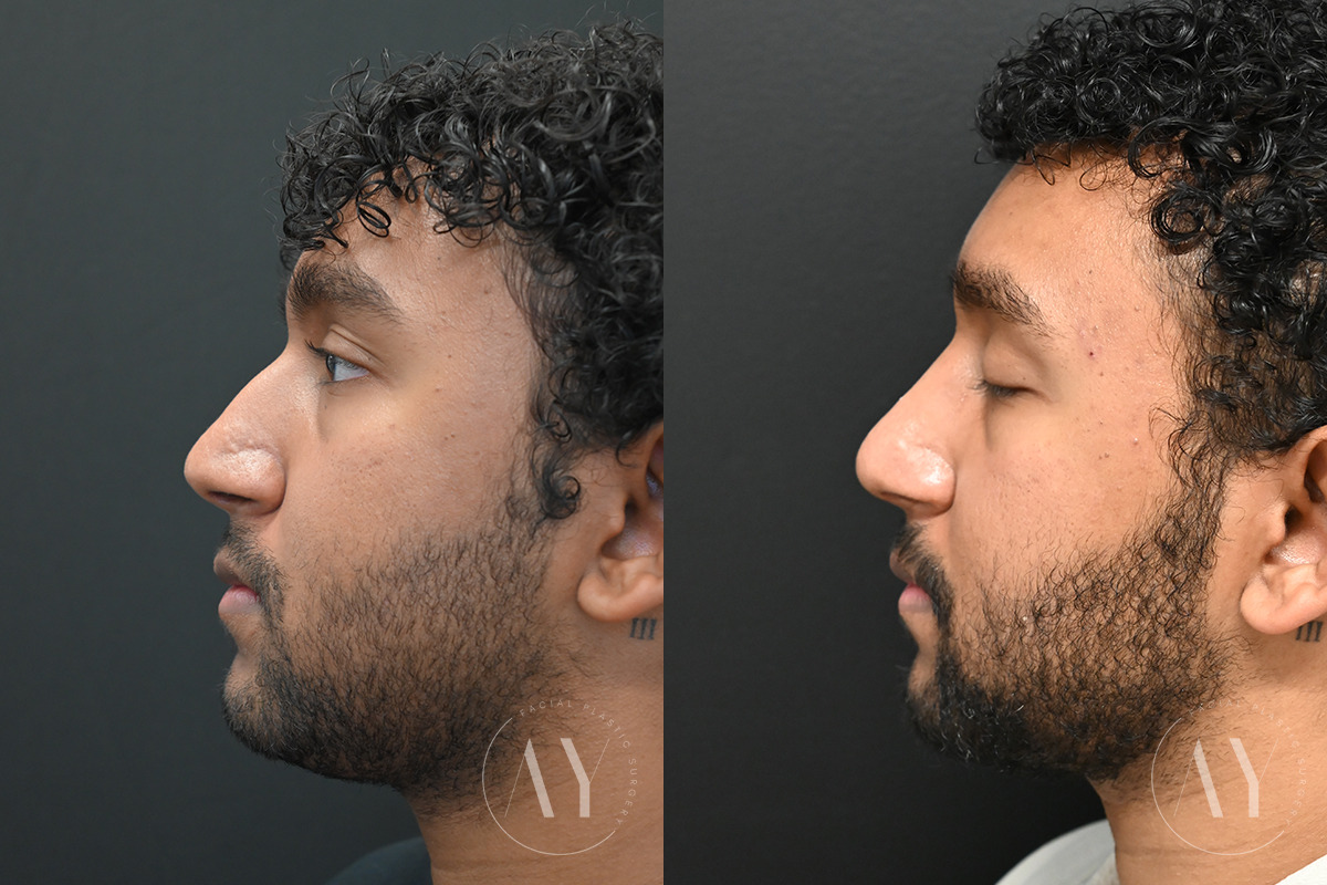Patient 6122, Rhinoplasty before and after photos Rhinoplasty before and after photos in Princeton, NJ, Patient 6122