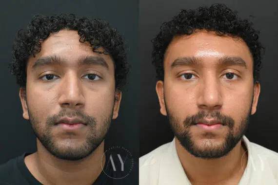 Rhinoplasty before and after photos in Princeton, NJ
