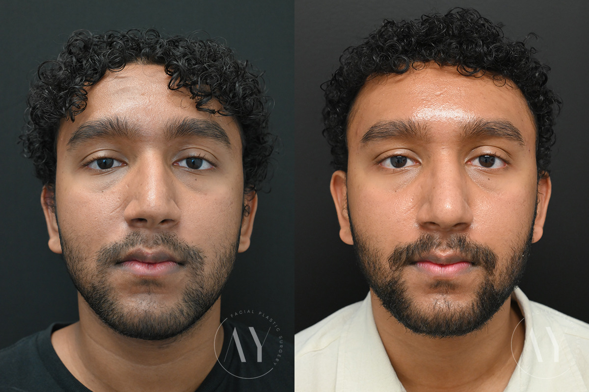 Patient 6122, Rhinoplasty before and after photos Rhinoplasty before and after photos in Princeton, NJ, Patient 6122