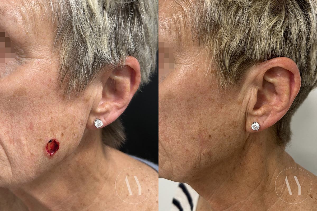 Mohs Reconstruction before and after photos in Princeton, NJ, Patient 6299