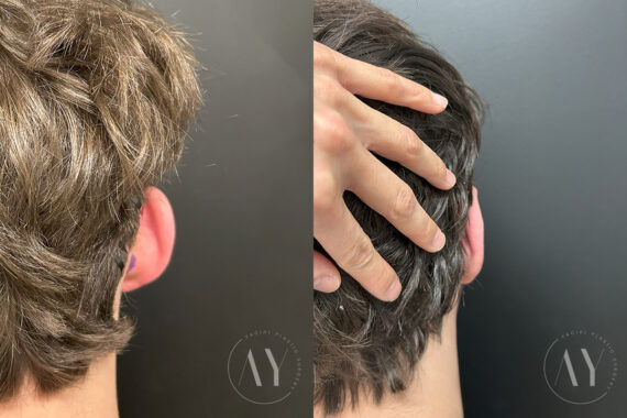 Otoplasty before and after photos in Princeton, NJ, Patient 6309