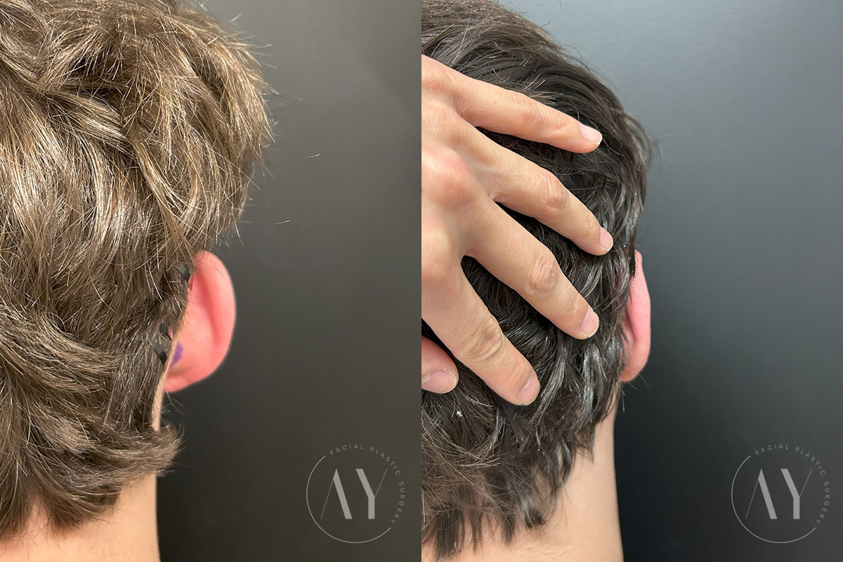 Otoplasty before and after photos in Princeton, NJ, Patient 6309