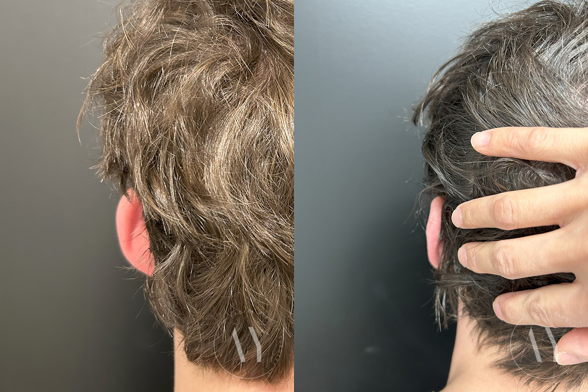 Otoplasty before and after photos in Princeton, NJ, Patient 6309