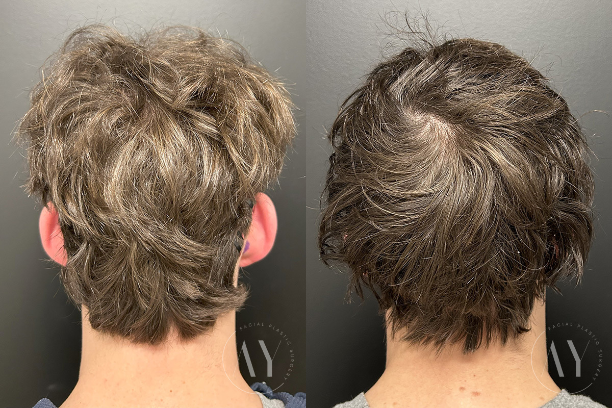 Otoplasty before and after photos in Princeton, NJ, Patient 6309