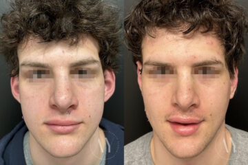 Otoplasty before and after photos in Princeton, NJ, Patient 6309