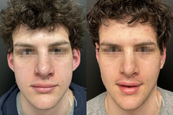 Otoplasty before and after photos in Princeton, NJ