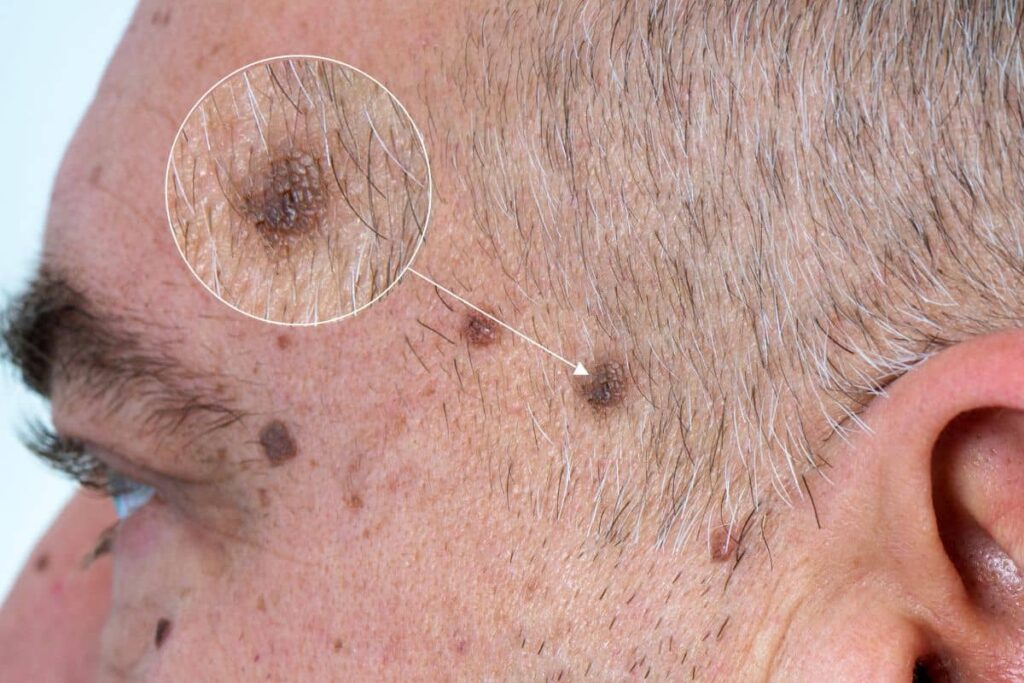 Zoomed-in image of pigmented facial lesion on a man's temple, showing warning signs of possible skin cancer recurrence.