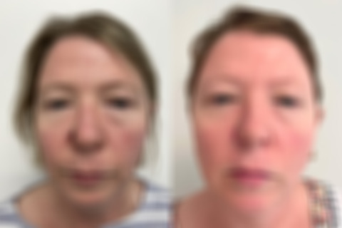 Mohs Reconstruction before and after photos in Princeton, NJ, Patient 4895