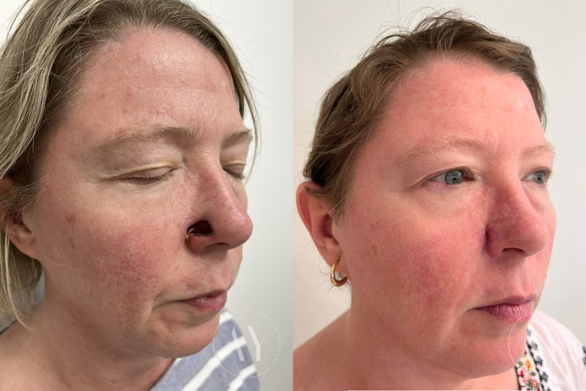 Mohs Reconstruction before and after photos in Princeton, NJ, Patient 4895