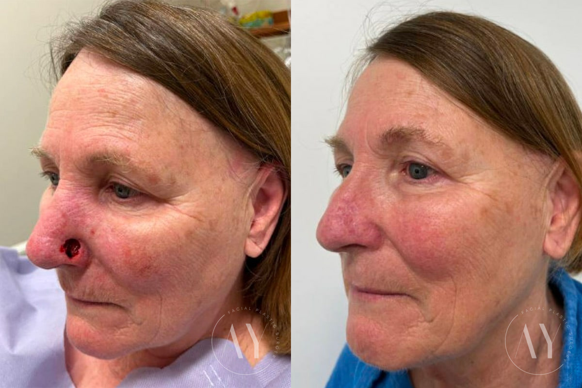 Mohs Reconstruction before and after photos in Princeton, NJ, Patient 4898