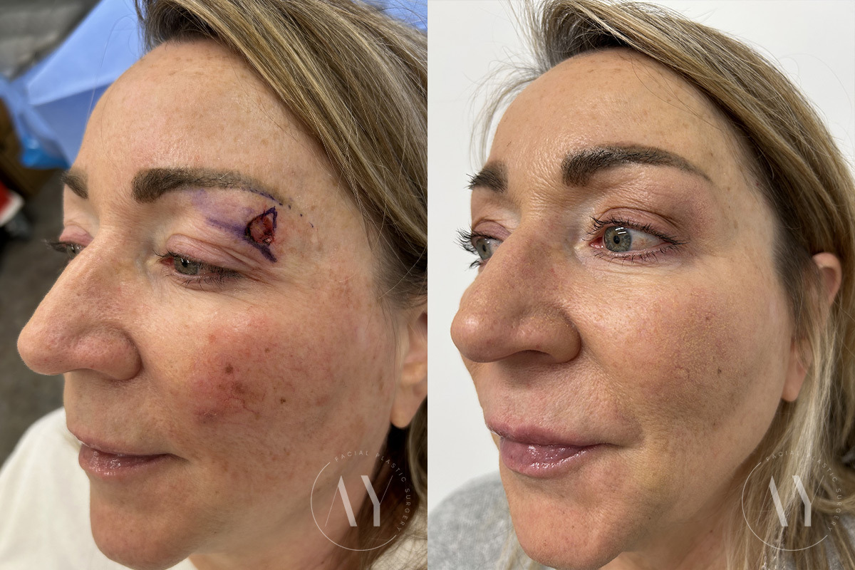 Mohs Reconstruction before and after photos in Princeton, NJ, Patient 6135