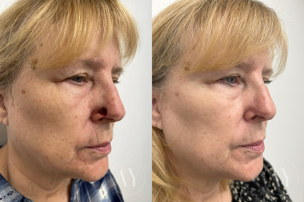 Mohs Reconstruction before and after photos in Princeton, NJ, Patient 6143