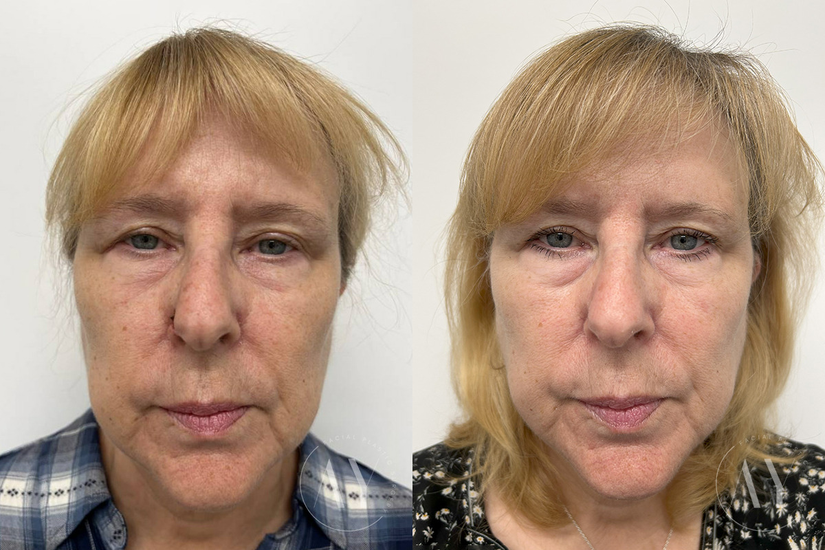 Mohs Reconstruction before and after photos in Princeton, NJ, Patient 6143