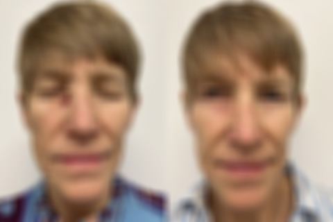 Mohs Reconstruction before and after photos in Princeton, NJ, Patient 6299