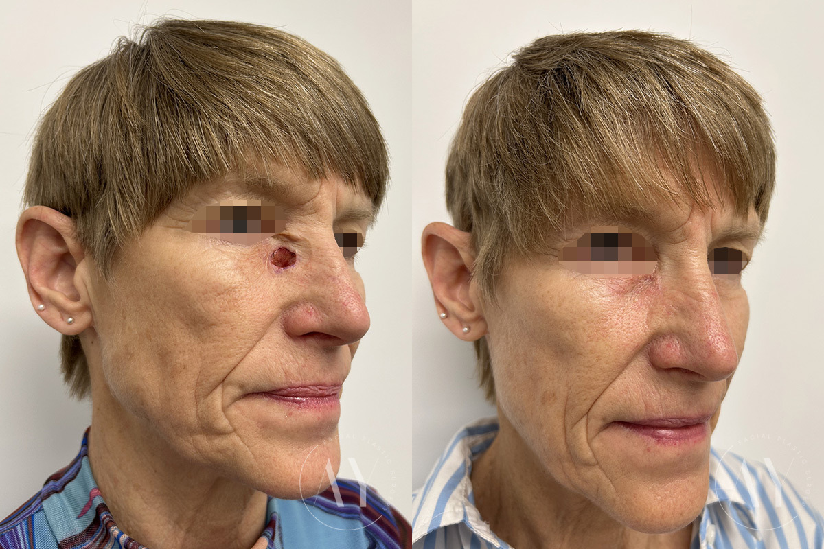 Mohs Reconstruction before and after photos in Princeton, NJ, Patient 6299