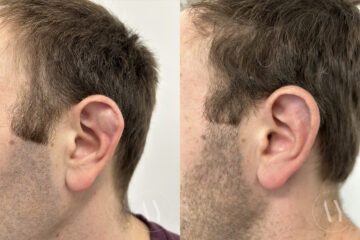 Cyst & Mass Removal before and after photos in Princeton, NJ, Patient 7482