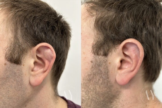 Cyst & Mass Removal before and after photos in Princeton, NJ