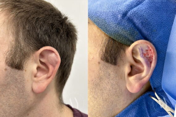 Cyst & Mass Removal before and after photos in Princeton, NJ, Patient 7482