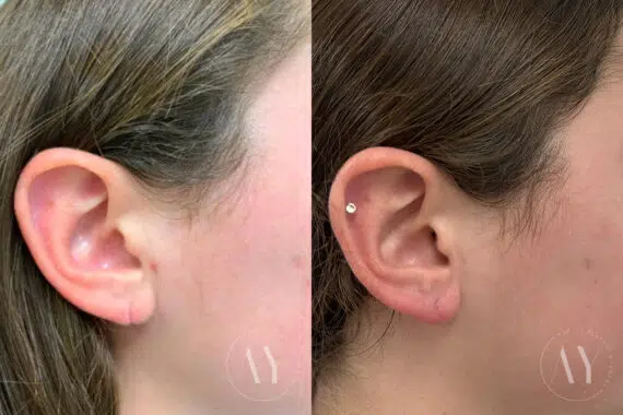 Earlobe Repair before and after photos in Princeton, NJ