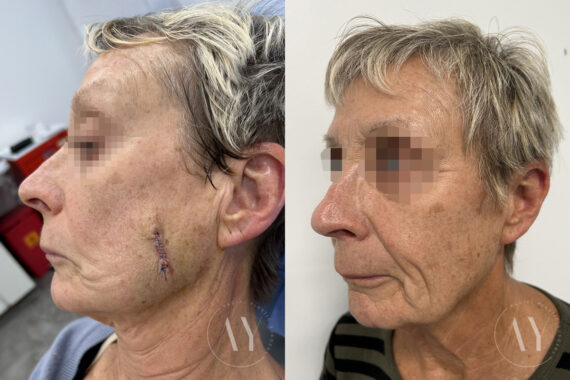 Mohs Reconstruction before and after photos in Princeton, NJ, Patient 7492