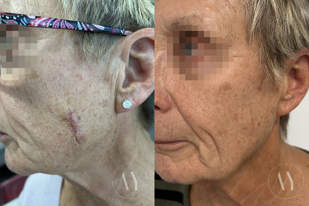 Mohs Reconstruction before and after photos in Princeton, NJ, Patient 7492