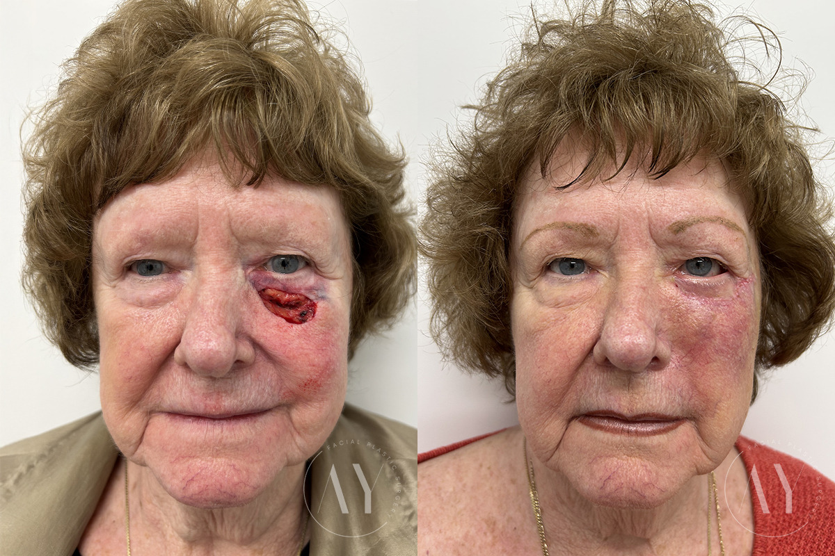Mohs Reconstruction before and after photos in Princeton, NJ, Patient 7505