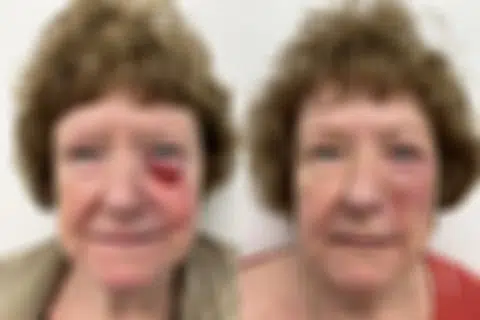 Mohs Reconstruction before and after photos in Princeton, NJ, Patient 7505