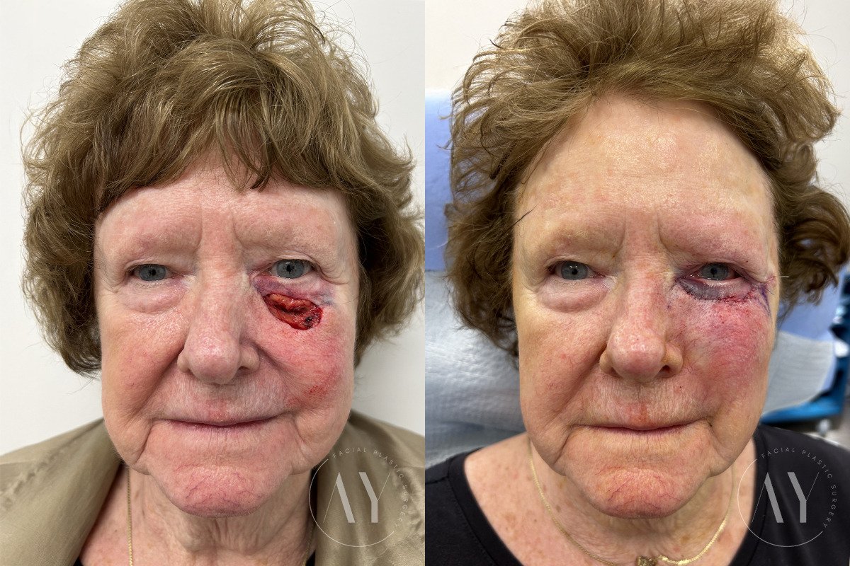 Mohs Reconstruction before and after photos in Princeton, NJ, Patient 7505