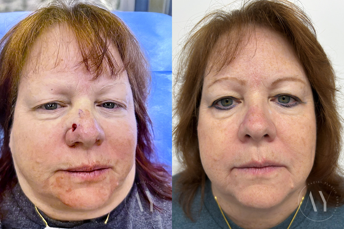 Mohs Reconstruction before and after photos in Princeton, NJ, Patient 7569