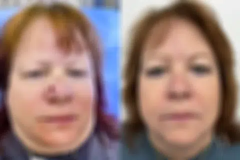 Mohs Reconstruction before and after photos in Princeton, NJ, Patient 7569