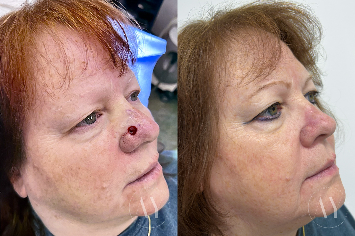 Mohs Reconstruction before and after photos in Princeton, NJ, Patient 7569