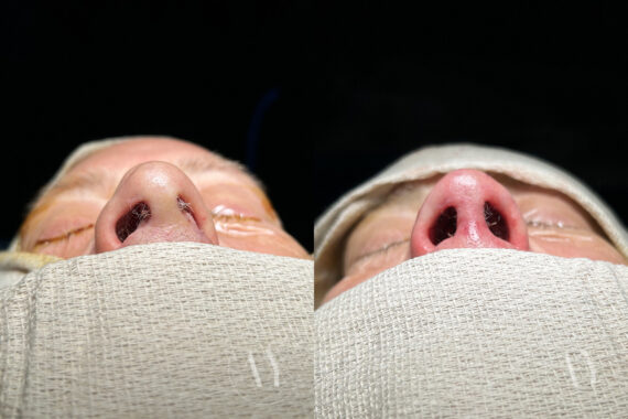 Rhinoplasty before and after photos in Princeton, NJ