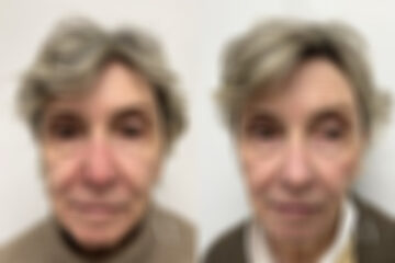 Mohs Reconstruction before and after photos in Princeton, NJ, Patient 7591
