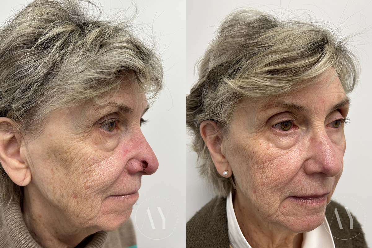 Mohs Reconstruction before and after photos in Princeton, NJ, Patient 7591