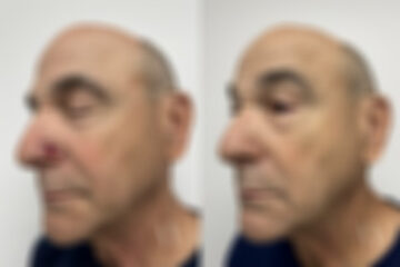Mohs Reconstruction before and after photos in Princeton, NJ, Patient 7598