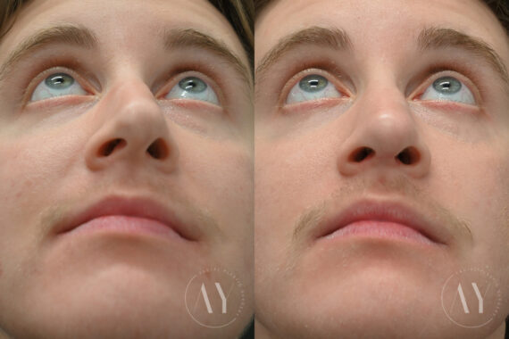Rhinoplasty before and after photos in Princeton, NJ