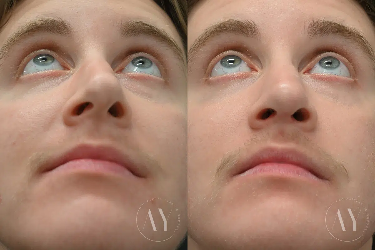 Rhinoplasty before and after photos in Princeton, NJ, Patient 7614