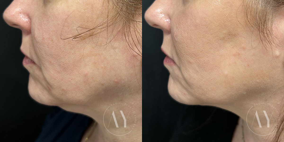 Neck Liposuction before and after photos in Princeton, NJ, Patient 7935