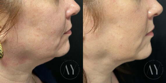 Neck Liposuction before and after photos in Princeton, NJ