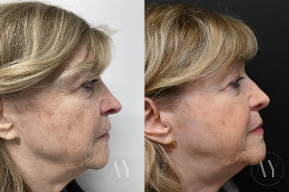 Revision Rhinoplasy before and after photos in Princeton, NJ, Patient 7942