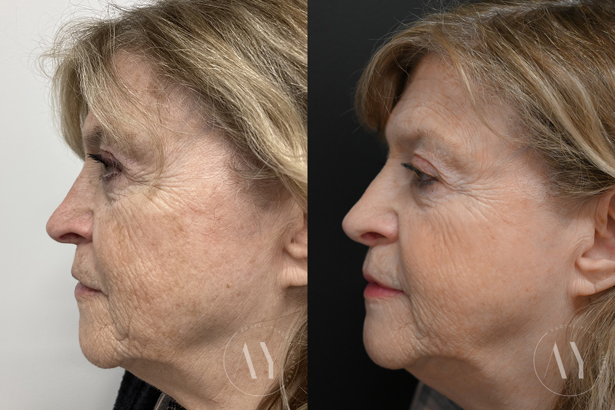 Revision Rhinoplasy before and after photos in Princeton, NJ, Patient 7942