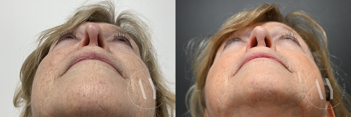 Revision Rhinoplasy before and after photos in Princeton, NJ, Patient 7942
