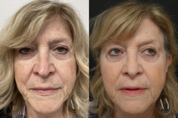 Revision Rhinoplasy before and after photos in Princeton, NJ, Patient 7942