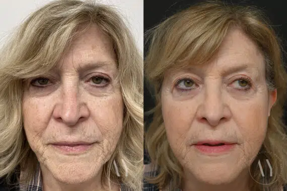 Revision Rhinoplasy before and after photos in Princeton, NJ, Patient 7942