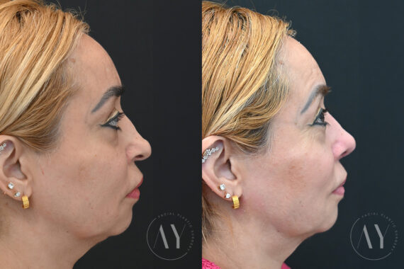Revision Rhinoplasy before and after photos in Princeton, NJ, Patient 7955