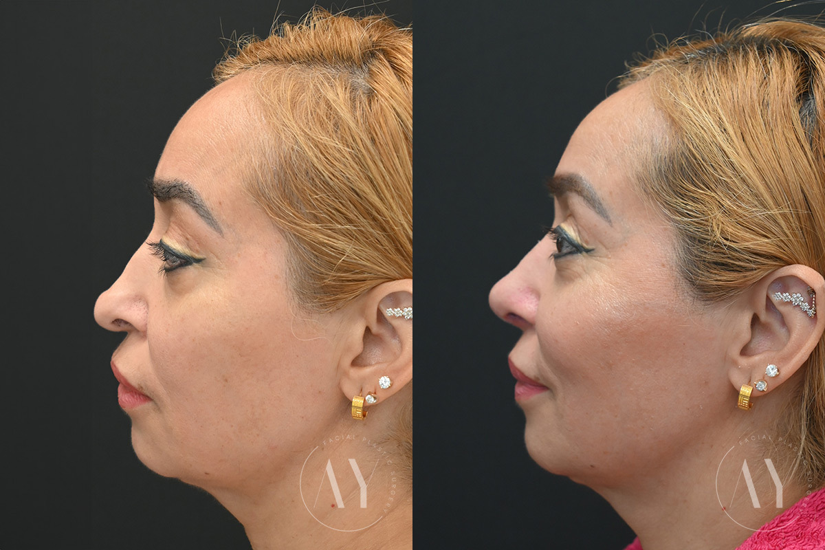 Revision Rhinoplasy before and after photos in Princeton, NJ, Patient 7955