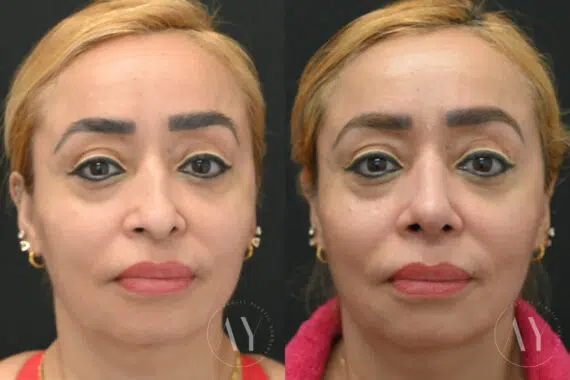 Revision Rhinoplasy before and after photos in Princeton, NJ, Patient 7955